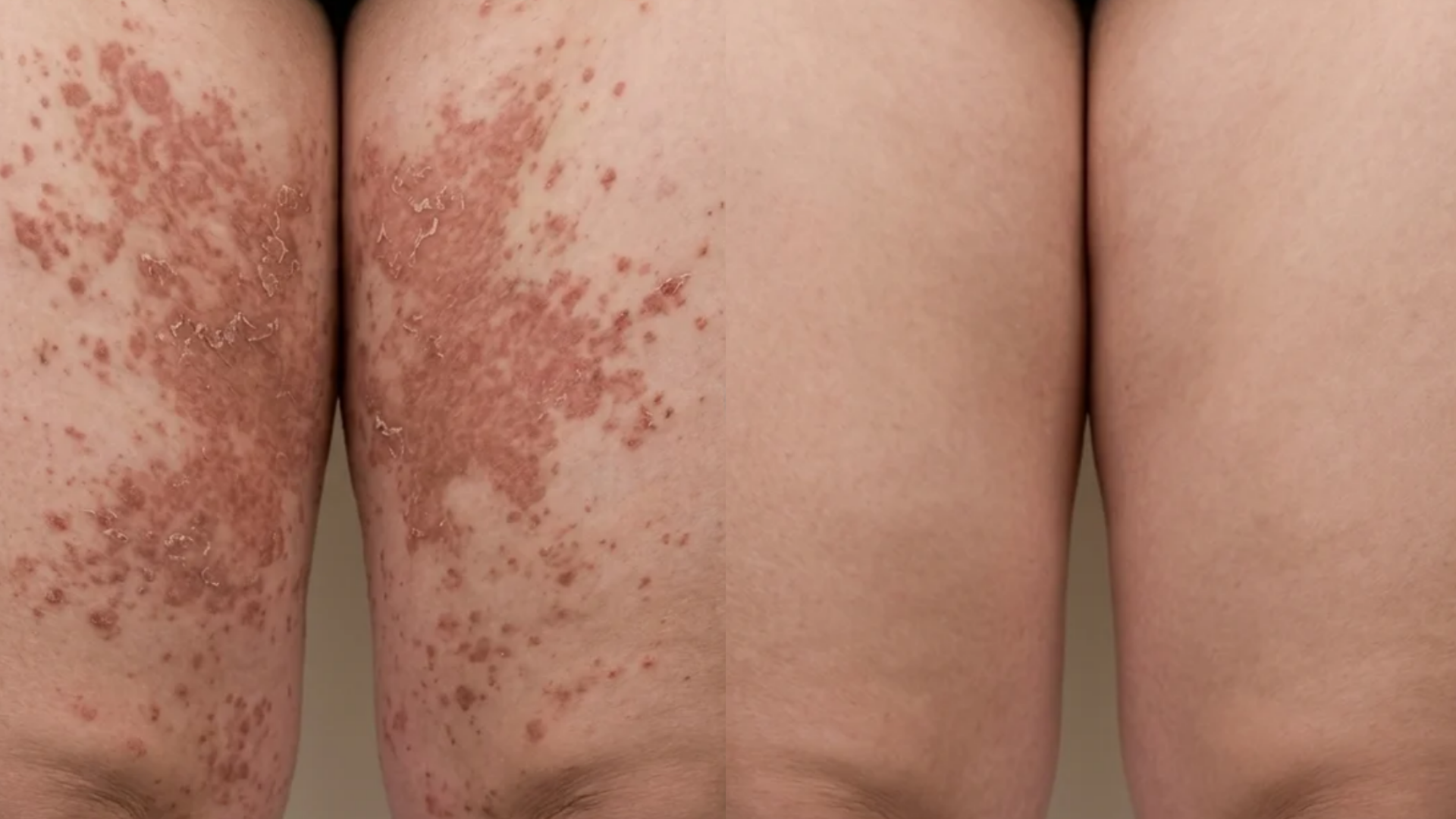 VOANA PDRN Repair Cream before and after — skin-fold rash, customer 4