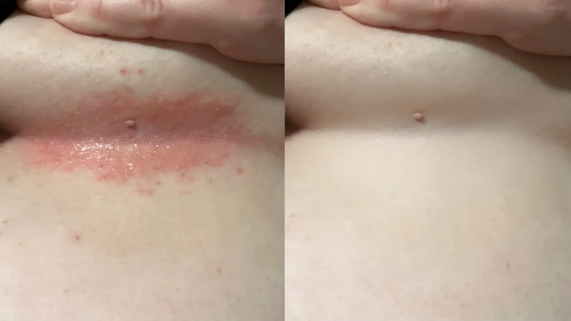 VOANA PDRN Repair Cream before and after — skin-fold rash, customer 5